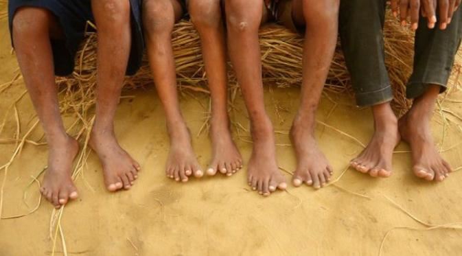 14 ahli keluarga de silva ini ada 12 jari tangan dan kaki