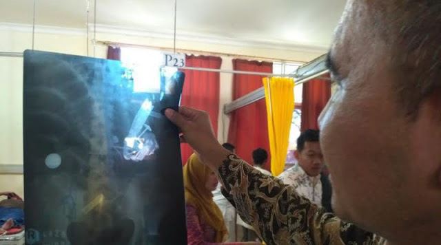 doktor bedah jumpa macam-macam dalam perut lelaki ni termasuk sudu besi, duit dan kayu ais krim