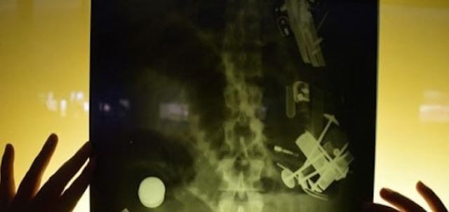 doktor bedah jumpa macam-macam dalam perut lelaki ni termasuk sudu besi, duit dan kayu ais krim