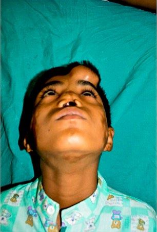 doktor tumbuhkan hidung palsu pada dahi kanak-kanak lelaki ini