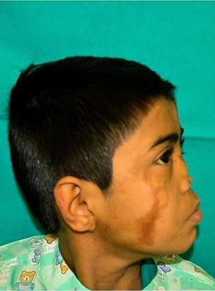 doktor tumbuhkan hidung palsu pada dahi kanak-kanak lelaki ini