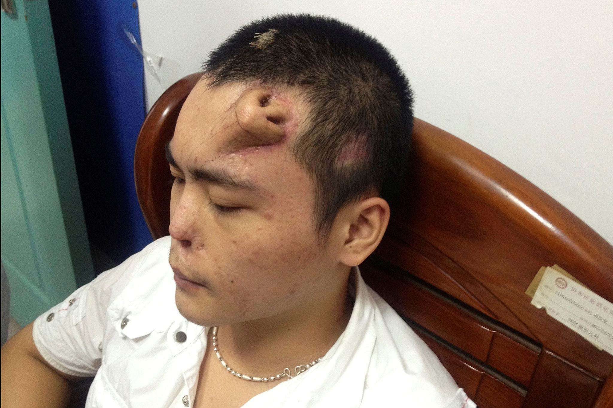 doktor tumbuhkan hidung palsu pada dahi kanak-kanak lelaki ini