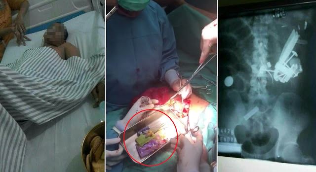 doktor bedah jumpa macam-macam dalam perut lelaki ni termasuk sudu besi, duit dan kayu ais krim