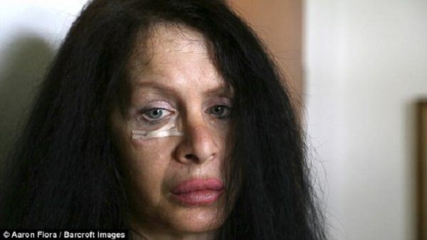 takutnya ! wanita ni sanggup suntik bakteria 3.5 juta tahun nak nampak muda