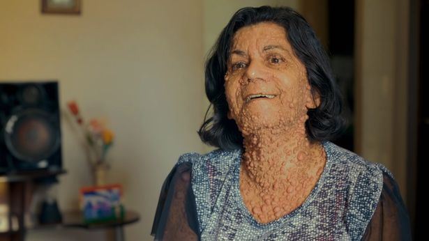 badan penuh biji macam buih, ibu ini tak malu dengan diri sendiri