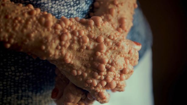 badan penuh biji macam buih, ibu ini tak malu dengan diri sendiri