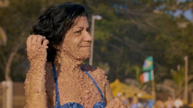 badan penuh biji macam buih, ibu ini tak malu dengan diri sendiri
