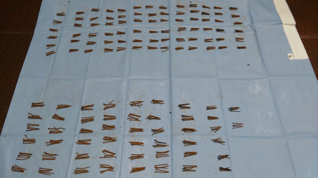 doktor guna magnet buang 600 paku dalam perut lelaki ini