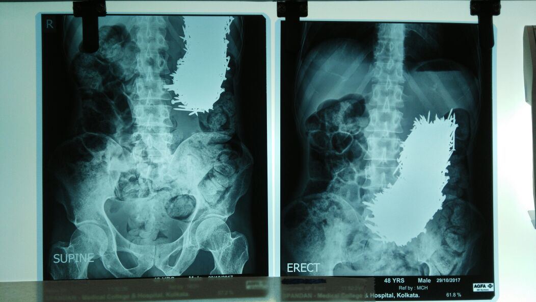 doktor guna magnet buang 600 paku dalam perut lelaki ini