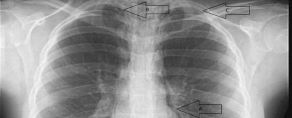 jerit kuat sangat masa konsert, peparu gadis ini ‘runtuh’ sebelah