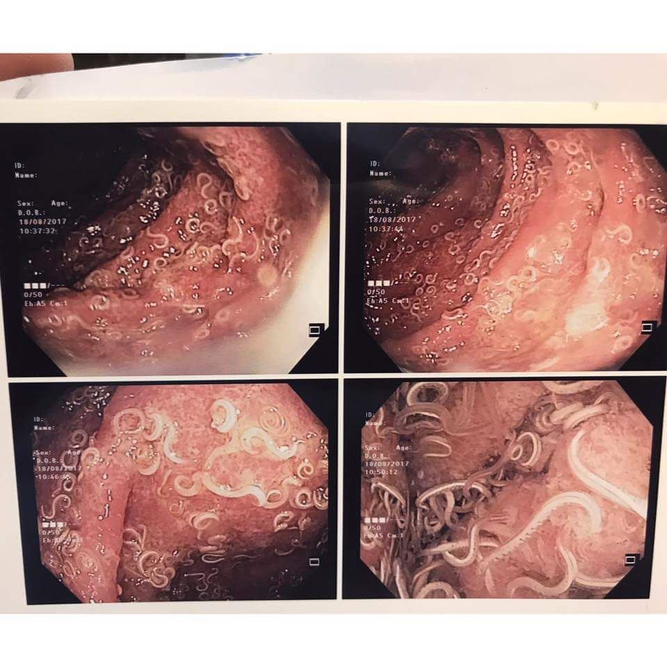 masalah kecacingan dalam perut ? doktor ni jelaskan perlu tak ambil ubat
