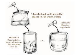 alamak ! gigi kekal patah, apa nak buat ? 