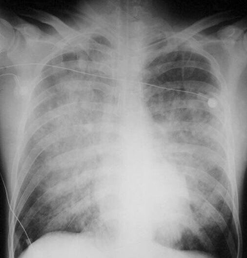 badan berlebih air dengan gemuk air sama ke ? ni jawapannya