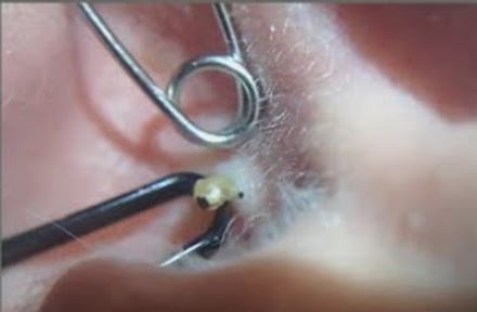 pakai headphone lama-lama boleh buat blackhead dalam telinga