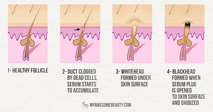 pakai headphone lama-lama boleh buat blackhead dalam telinga