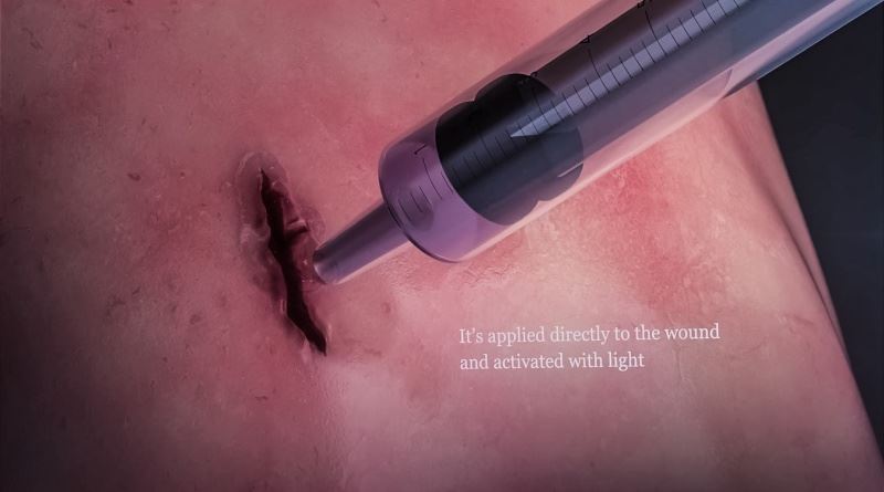 saintis cipta gam boleh tampal luka, 60 saat je dah elok