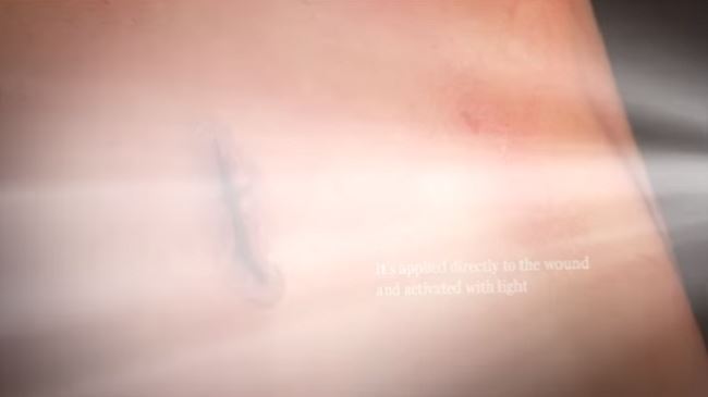 saintis cipta gam boleh tampal luka, 60 saat je dah elok