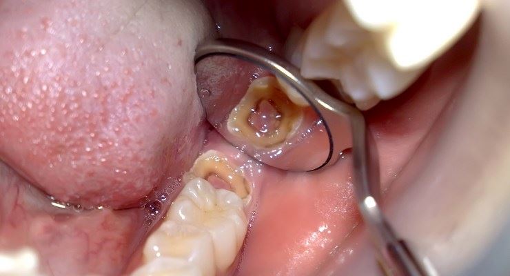 3 perkara ini adalah punca kepada masalah gigi berlubang