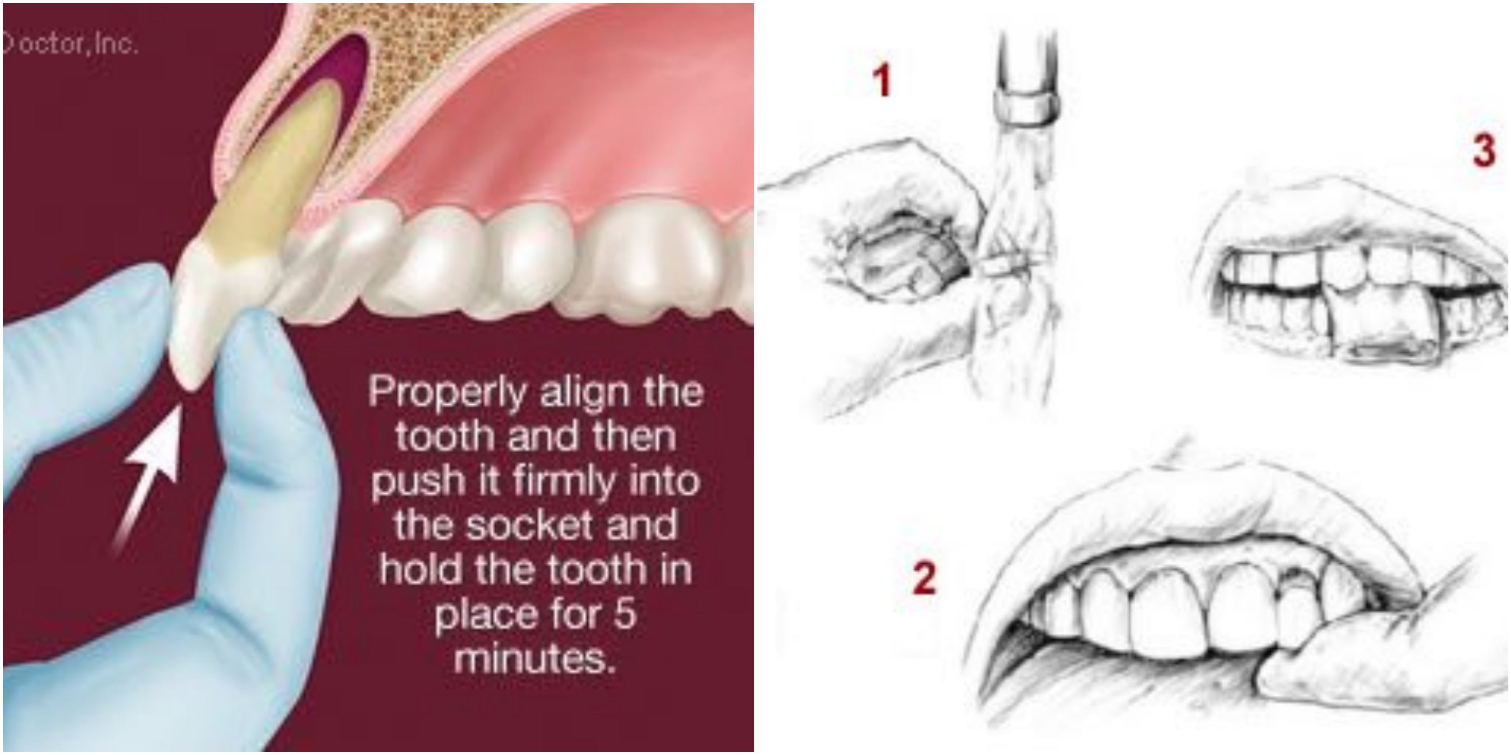 alamak ! gigi kekal patah, apa nak buat ? 