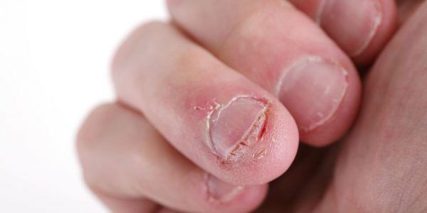 suka gigit kuku ? cuba buat 4 perkara ni 