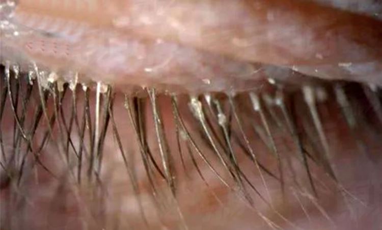 ewww! tak tukar cadar 5 tahun, kutu bersarang kat kelopak mata