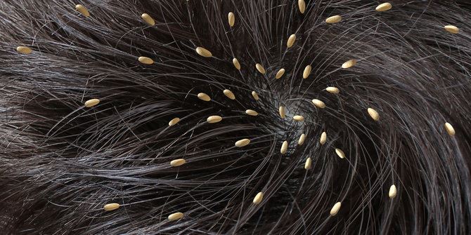 3 langkah mudah nak bunuh kutu kat kepala