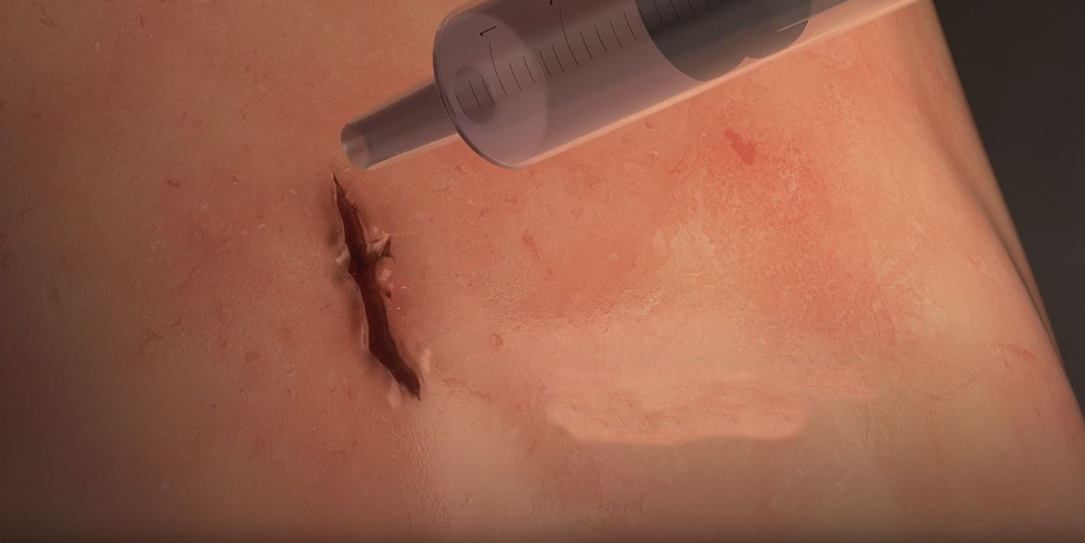 saintis cipta gam boleh tampal luka, 60 saat je dah elok