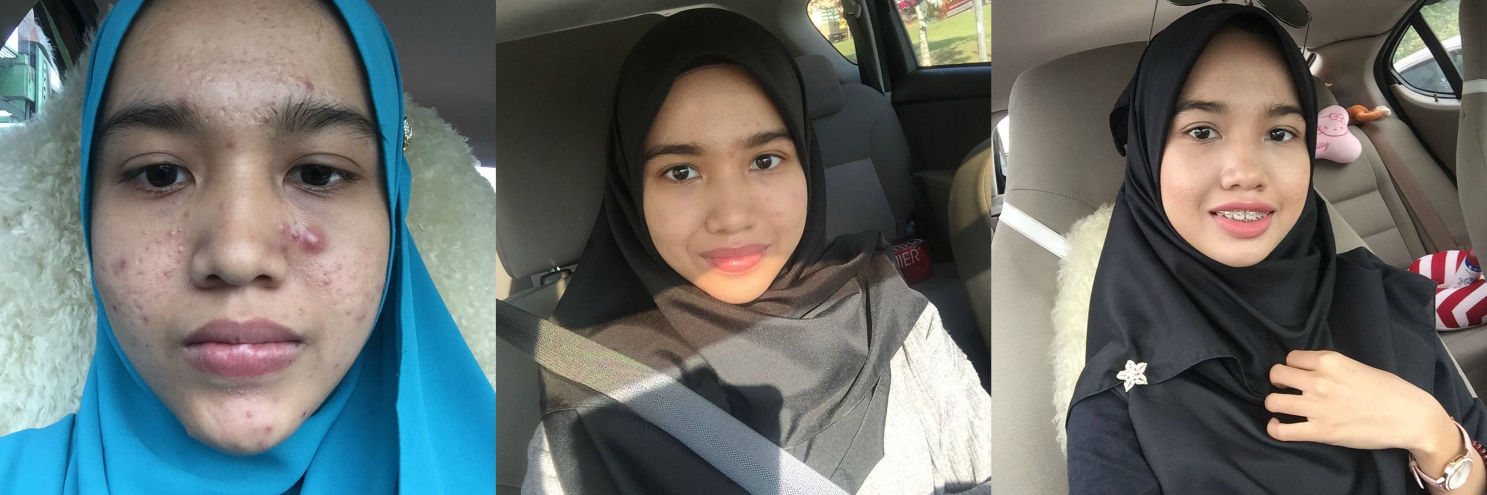 selepas 4 bulan daripada jerawat besar penuh muka terus licin, guna tips ni