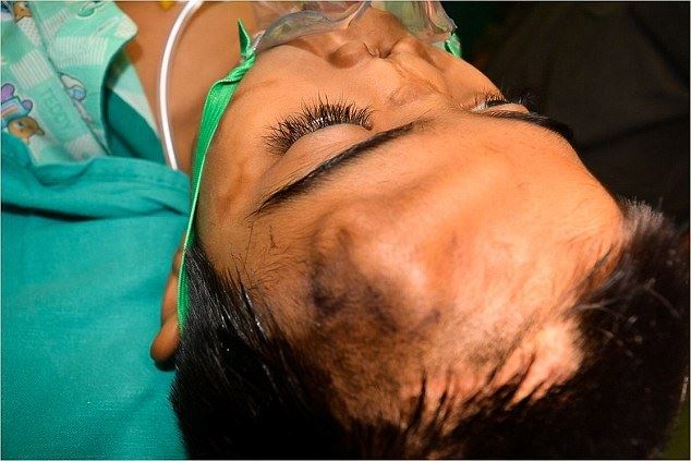 doktor tumbuhkan hidung palsu pada dahi kanak-kanak lelaki ini