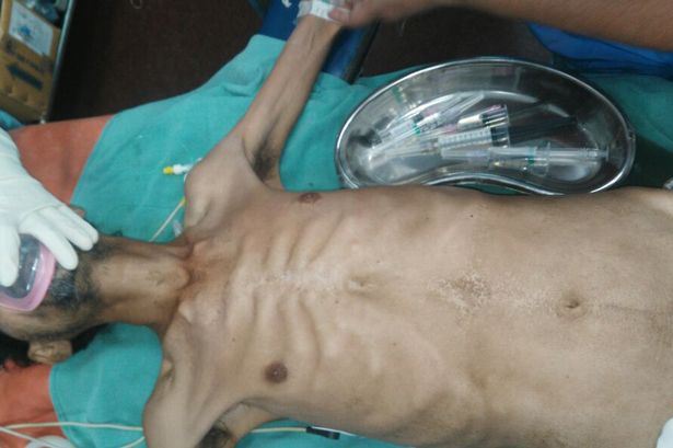 doktor guna magnet buang 600 paku dalam perut lelaki ini