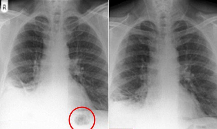disangka hidap tumor pada paru-paru, rupanya lelaki ini tertelan kon trafik