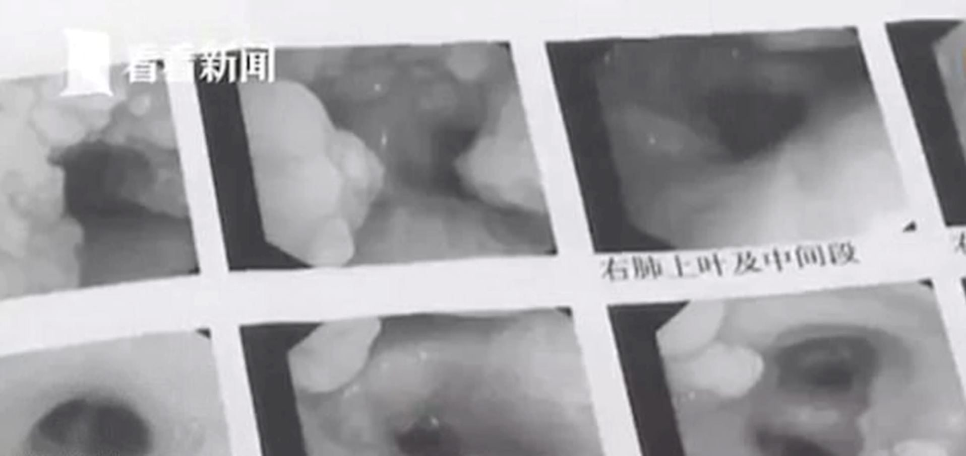 berpuluh-puluh gigi tumbuh di salur tekak jadi punca sukar bernafas