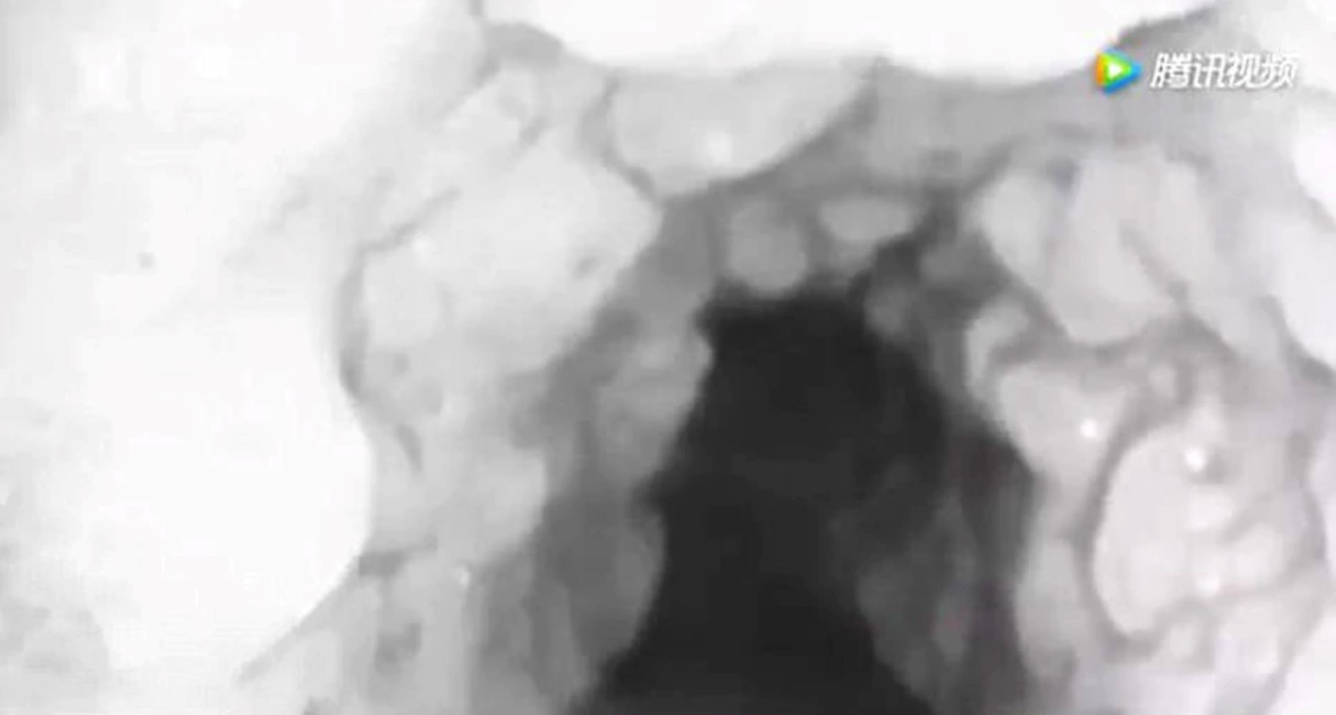 berpuluh-puluh gigi tumbuh di salur tekak jadi punca sukar bernafas