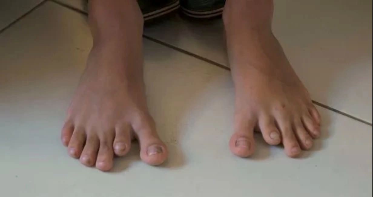 14 ahli keluarga de silva ini ada 12 jari tangan dan kaki