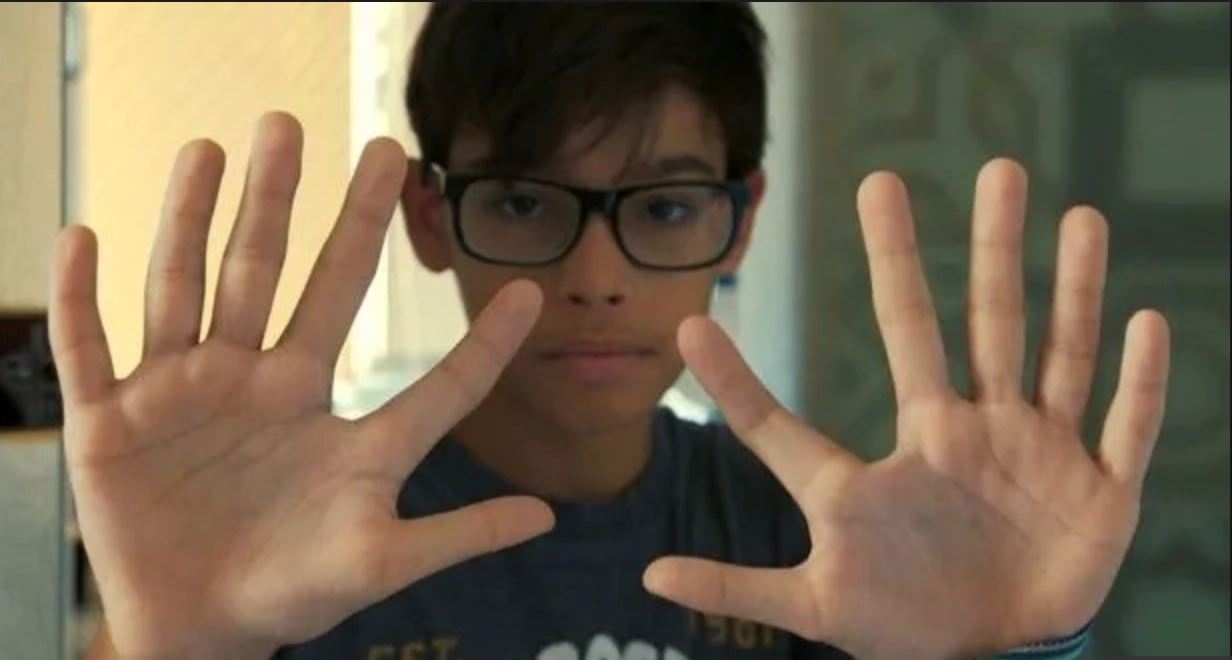 14 ahli keluarga de silva ini ada 12 jari tangan dan kaki