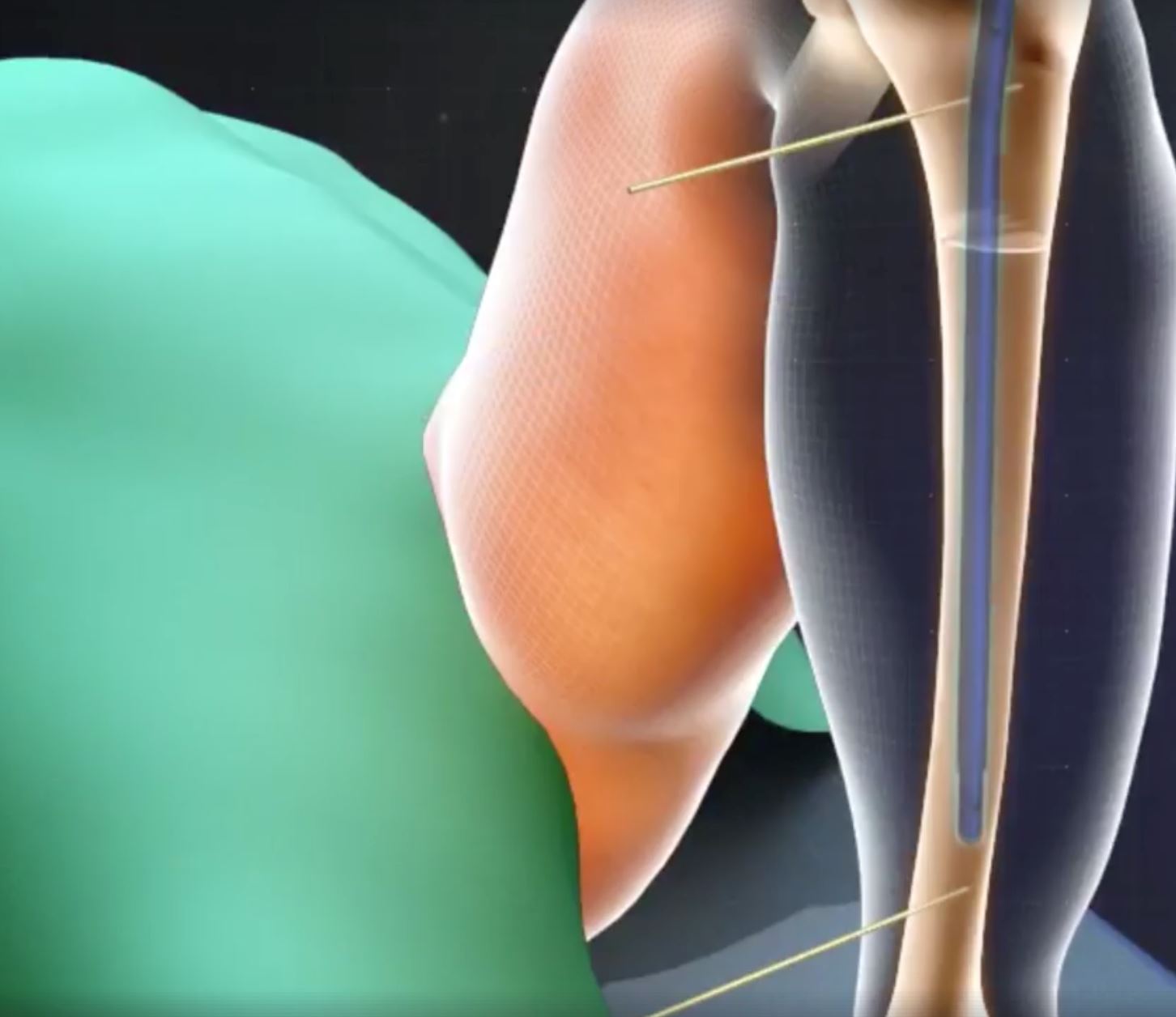 pembedahan ini khas untuk orang rendah yang nak sangat jadi tinggi