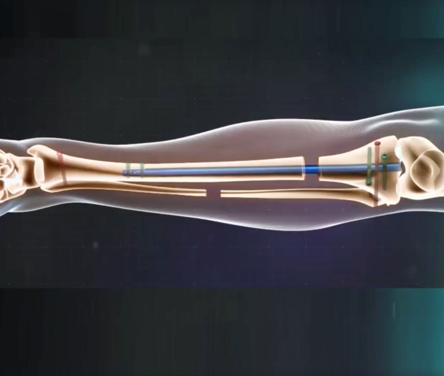 pembedahan ini khas untuk orang rendah yang nak sangat jadi tinggi