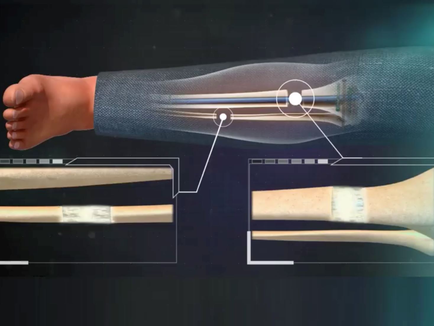 pembedahan ini khas untuk orang rendah yang nak sangat jadi tinggi