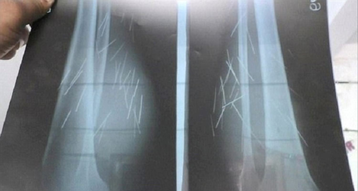 jarum dan pin antara 70 objek tajam yang keluar daripada kaki wanita ini