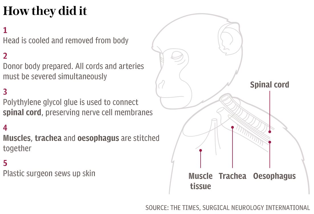 permindahan kepala monyet berjaya, akan guna pada manusia disember ni