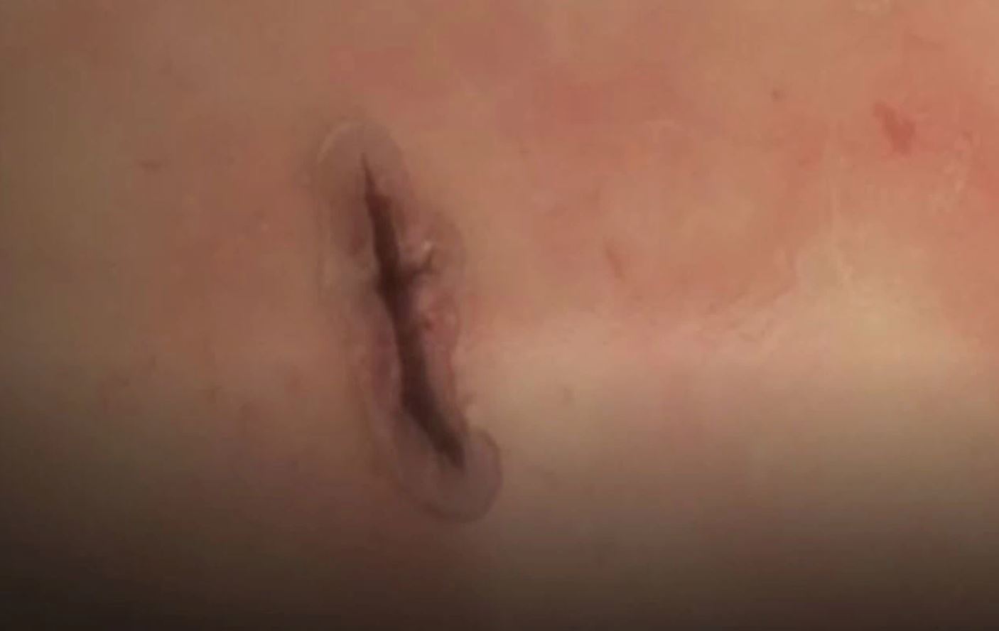 saintis cipta gam boleh tampal luka, 60 saat je dah elok