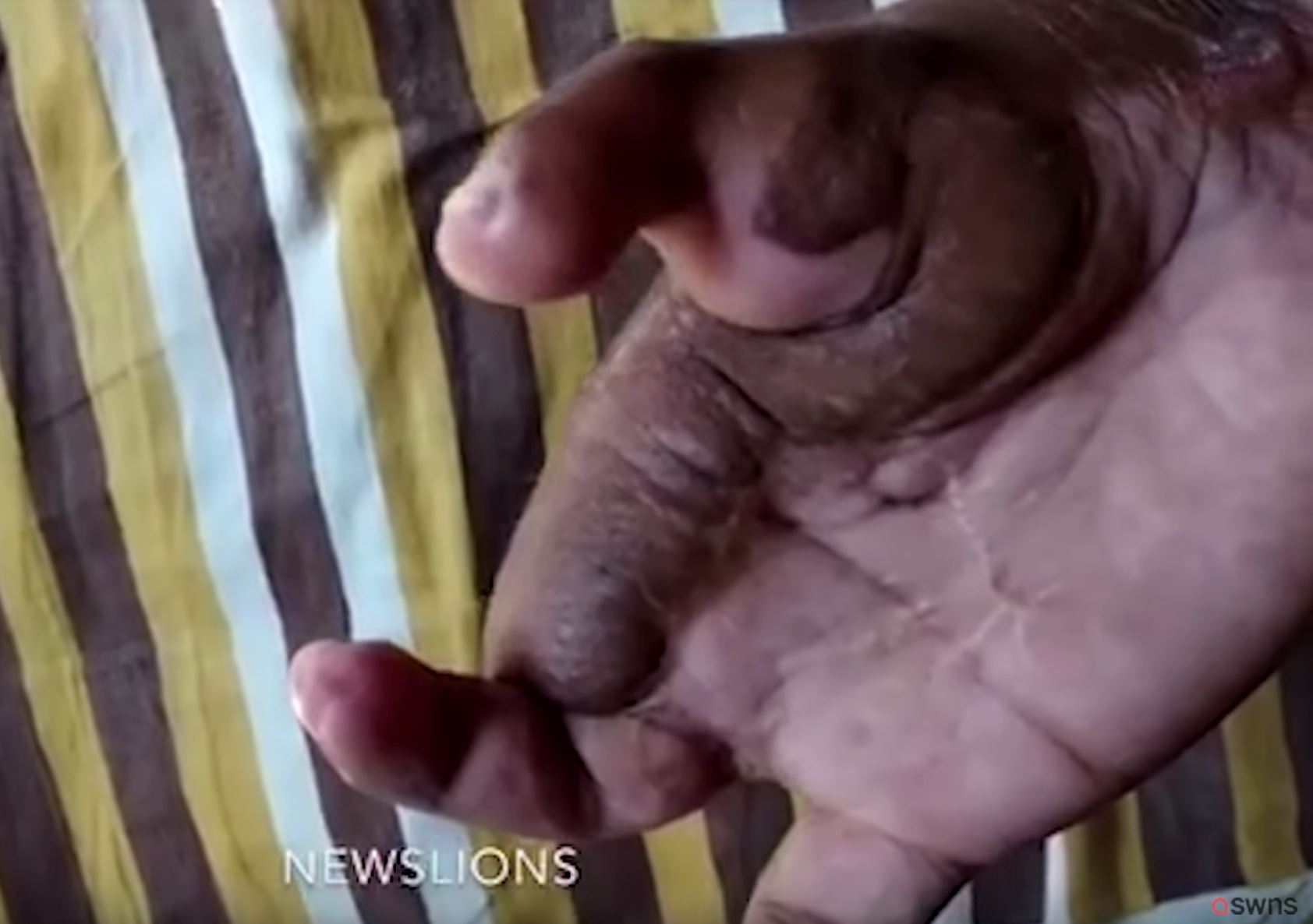 tiada pilihan, doktor gantikan jari tangan yang hilang dengan jari kaki