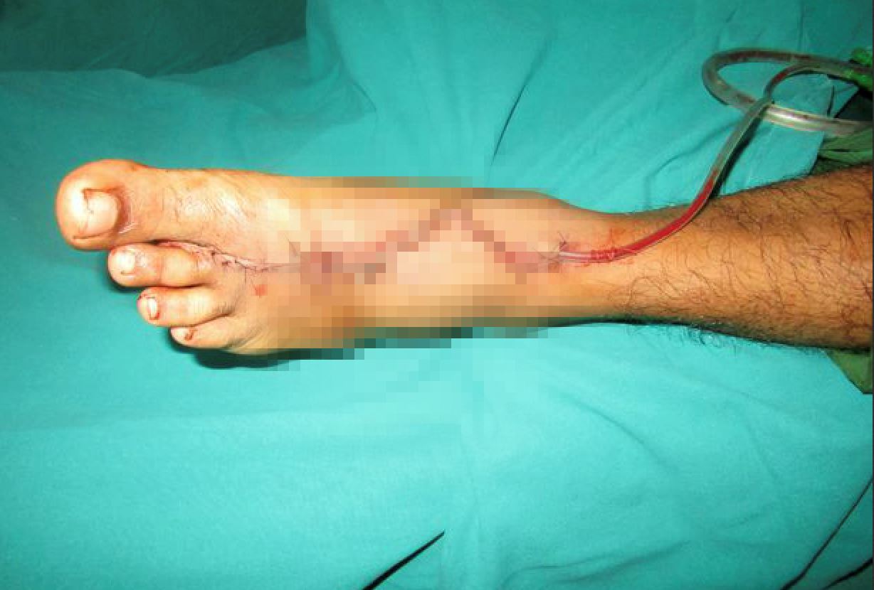 tiada pilihan, doktor gantikan jari tangan yang hilang dengan jari kaki