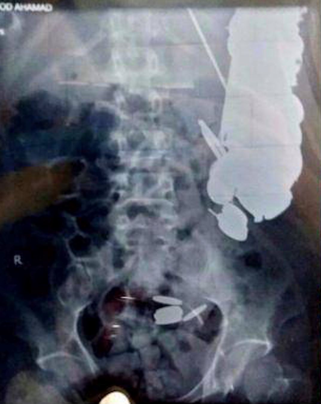 perut jadi tabung, doktor jumpa 263 keping syiling dalam perut lelaki ini