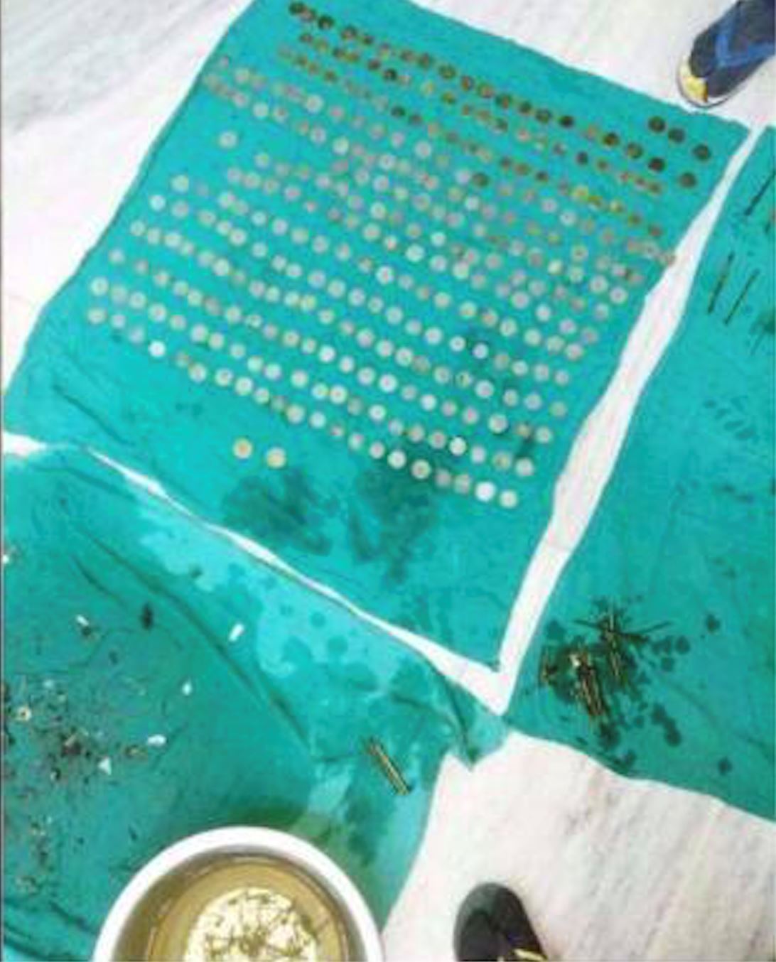 perut jadi tabung, doktor jumpa 263 keping syiling dalam perut lelaki ini