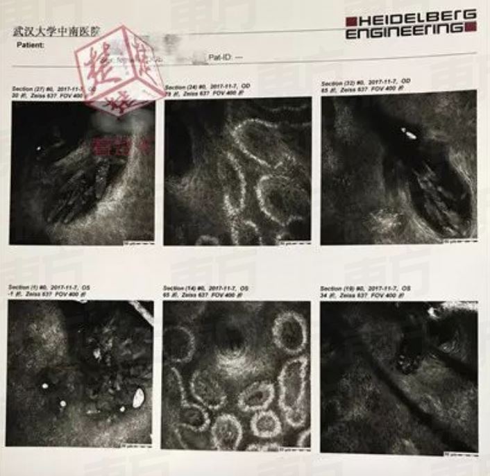 ewww! tak tukar cadar 5 tahun, kutu bersarang kat kelopak mata