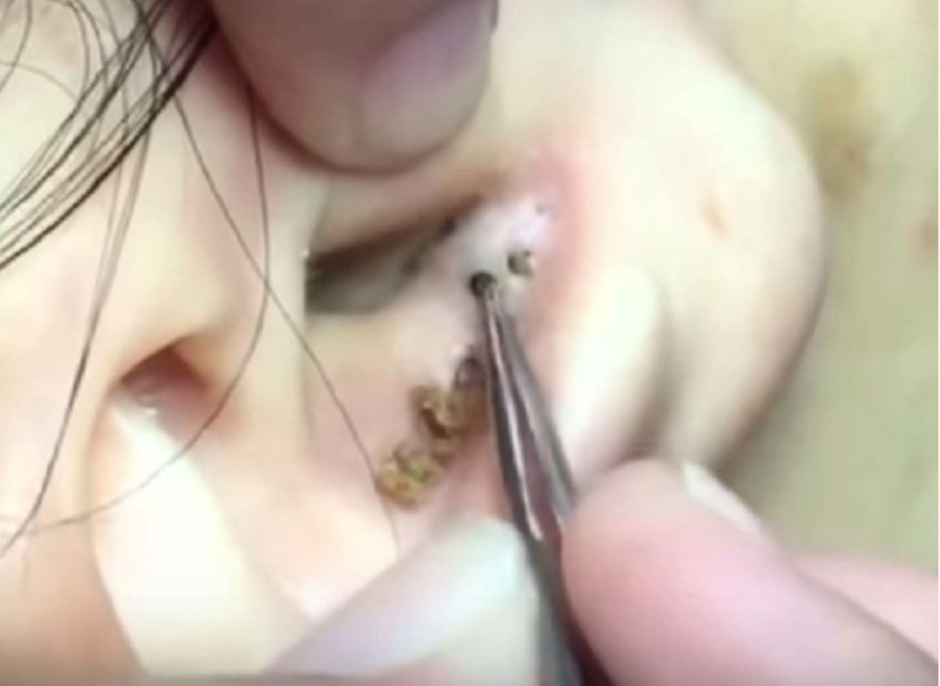 pakai headphone lama-lama boleh buat blackhead dalam telinga