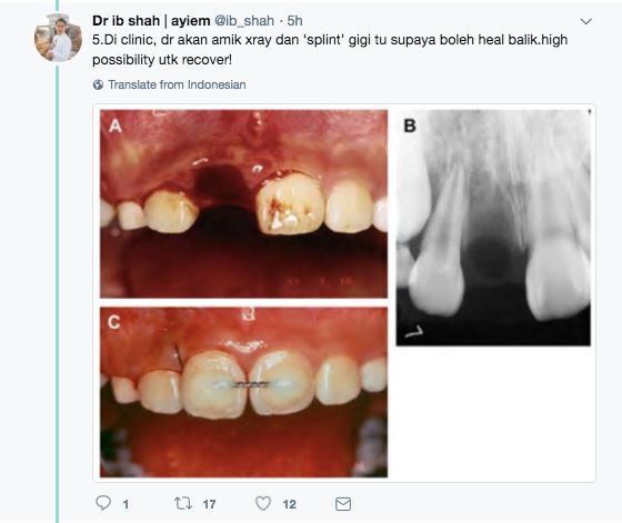 alamak ! gigi kekal patah, apa nak buat ? 