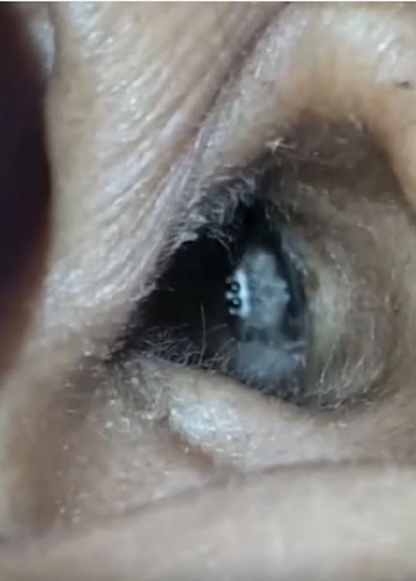 selalu sakit kepala, bila check ada labah-labah masih hidup dalam telinga