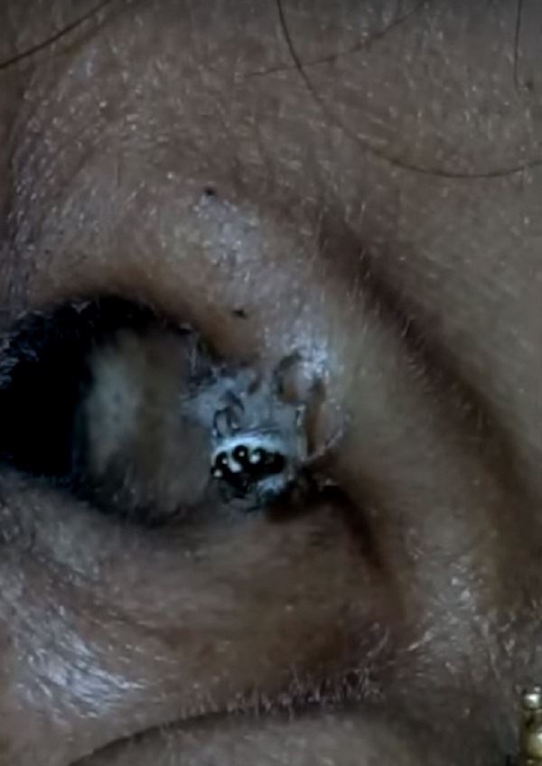 selalu sakit kepala, bila check ada labah-labah masih hidup dalam telinga